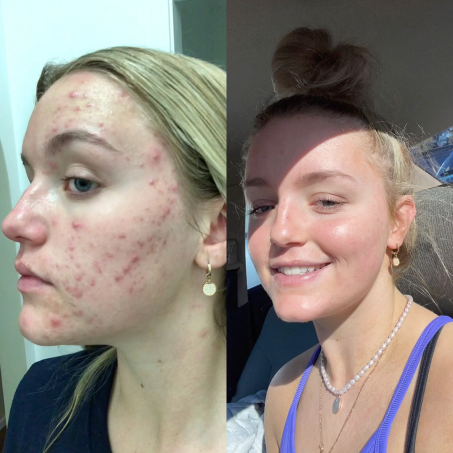 Before and after — Lysa results