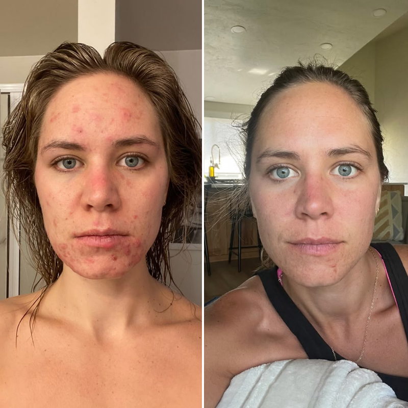 Hormonal Breakouts Stop in Just 5 Days