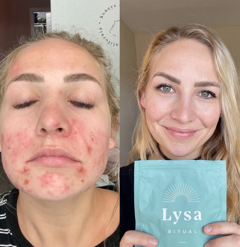 In Ancient Remedies Nobody Has Acne — Not the Young, Not the Old