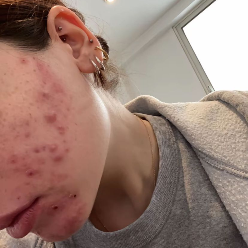 Understanding Hormonal Acne
