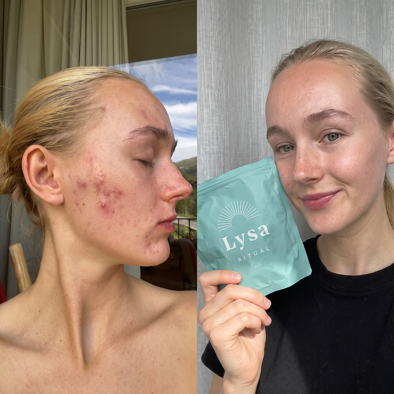 Erases acne in 9 days without chemicals