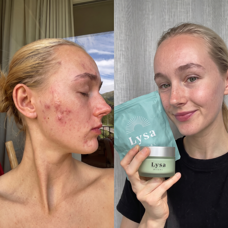 Erases acne in 9 days without chemicals