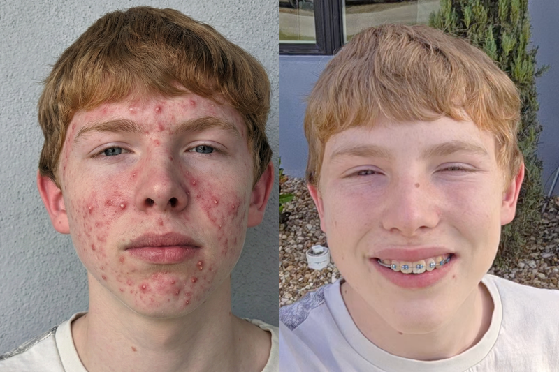 How to Get Clearer Skin Faster