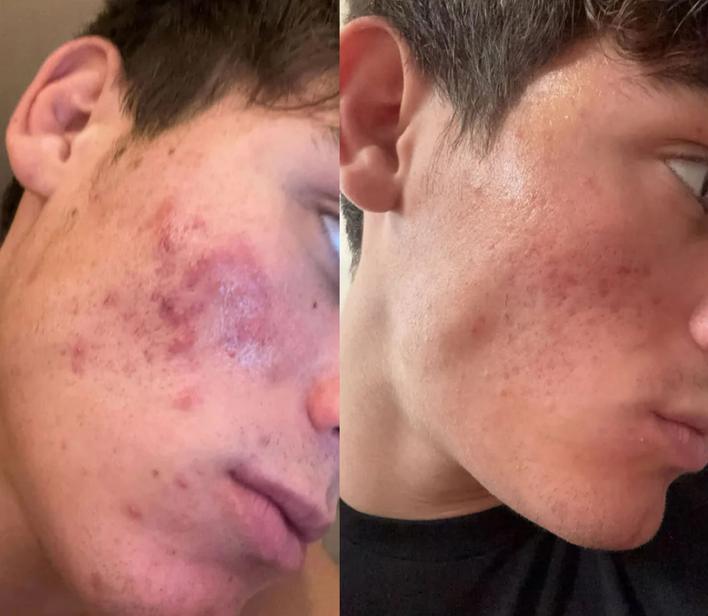 Hormonal Breakouts Stop in Just 5 Days