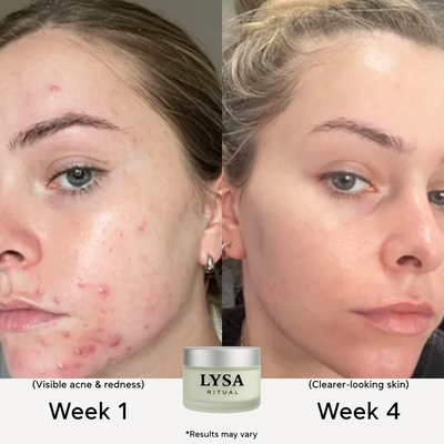 Lysa Acne